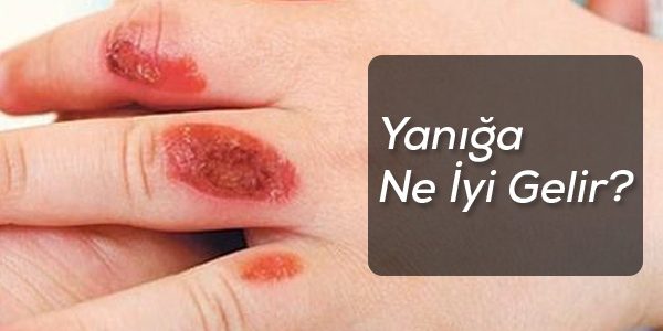 yanık